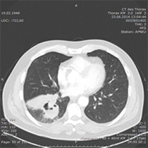 Lungenkrebs Lungenkazinom